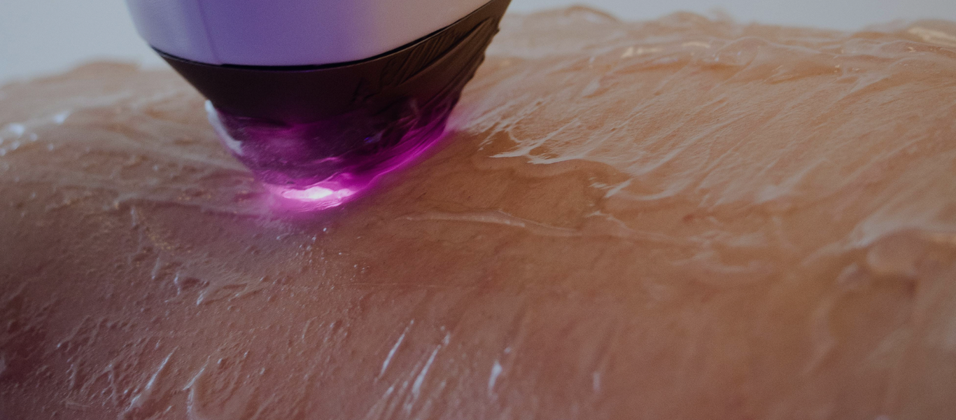 Min Hud IPL behandlingar i stockholm